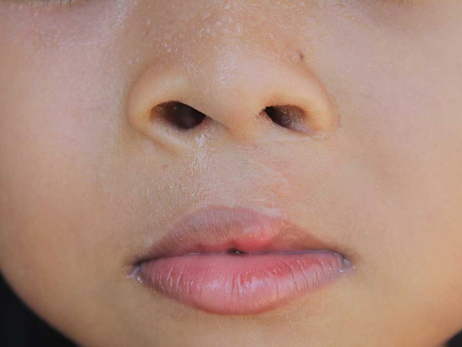 Memahami Bibir Sumbing: Penyebab, Diagnosis, dan Pengobatan