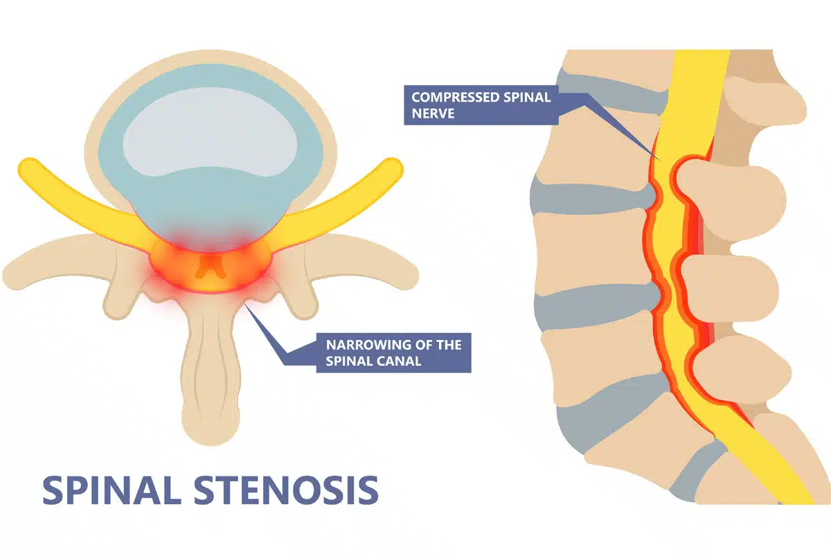 Stenosis: Ketika Saluran di Tubuh Menyempit